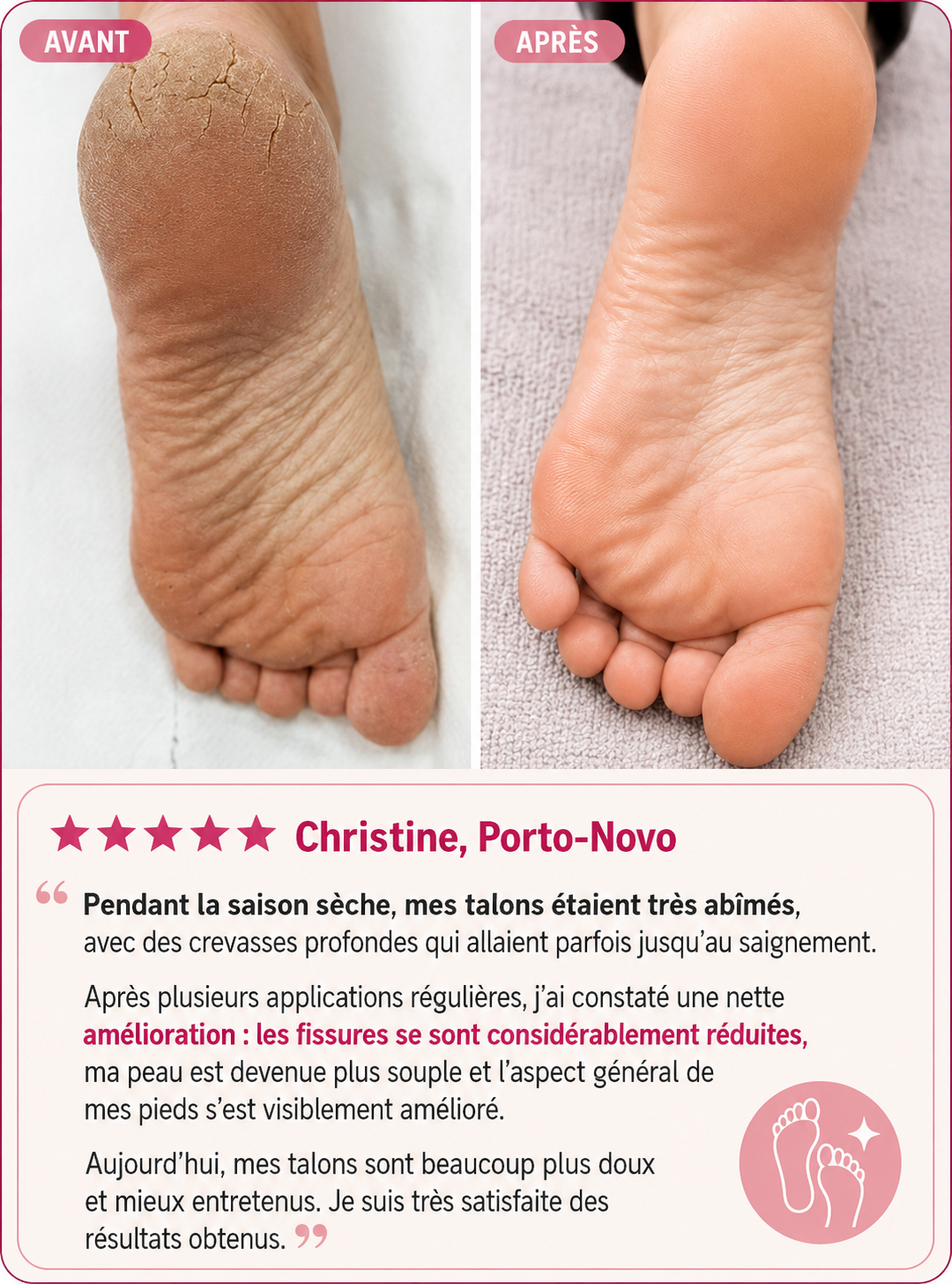 PediLisse+™ – Élimination Rapide des Callosités et Talons Fissurés